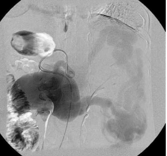 SPLENIC ARTERY ANEURYSM
