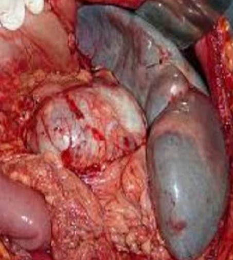 SPLENIC ARTERY ANEURYSM