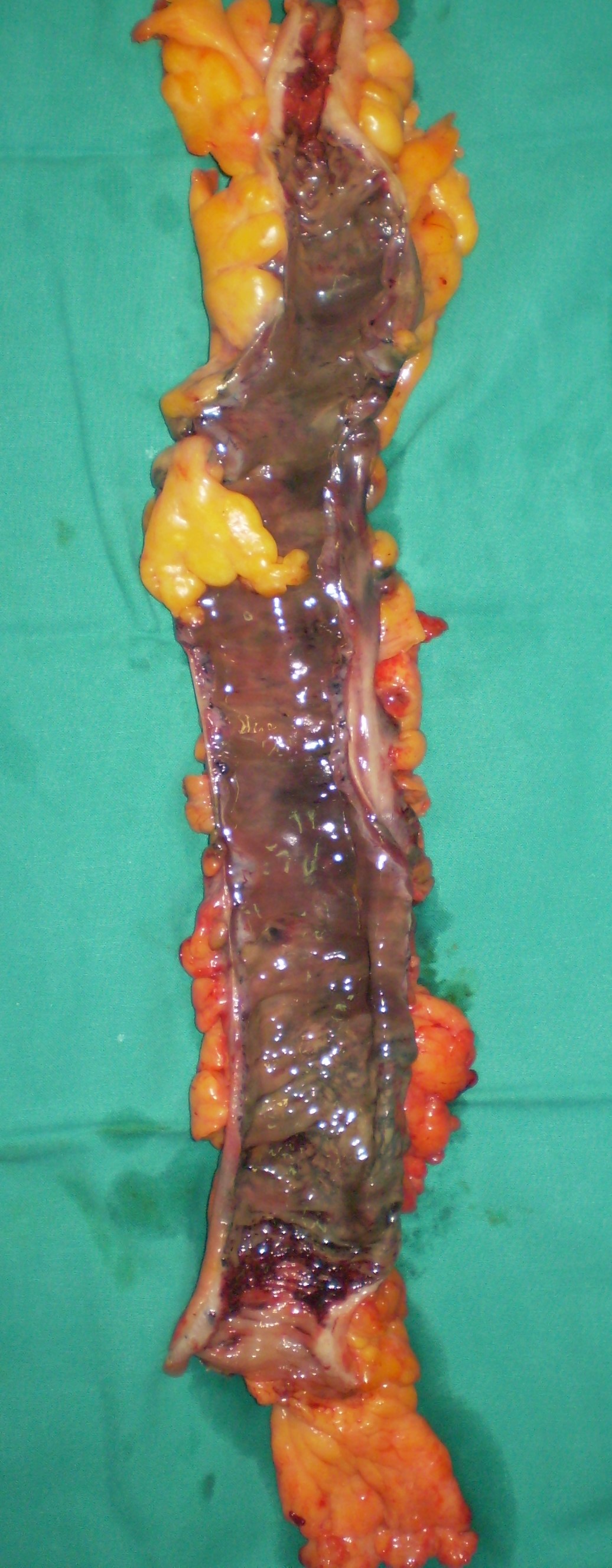 RUPTURED ABDOMINAL AORTIC ANEURYSM - SIGMOID ISCHAEMIA