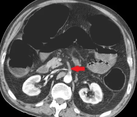 SUPERIOR MESENTERIC ARTERY EMBOLUS