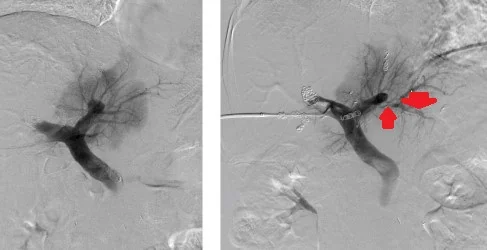 ACUTE THROMBOSIS LEFT PORTAL VEIN