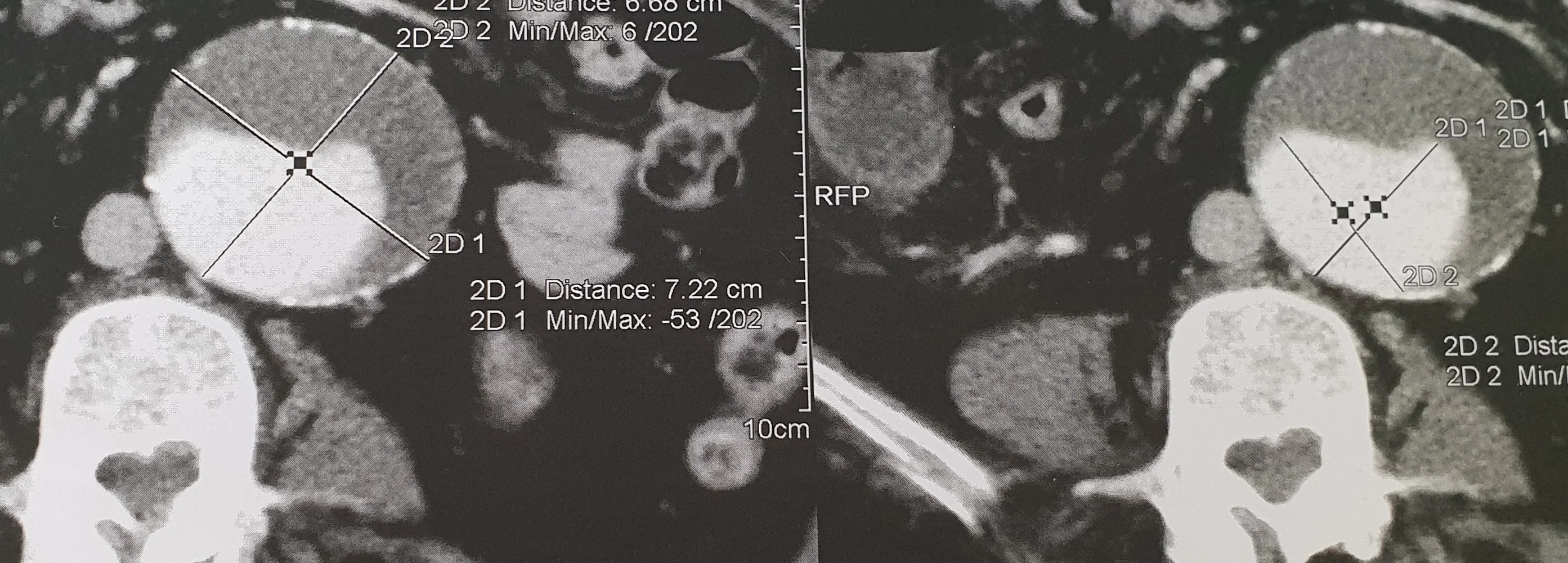 ABDOMINAL AORTIC ANEURYSM