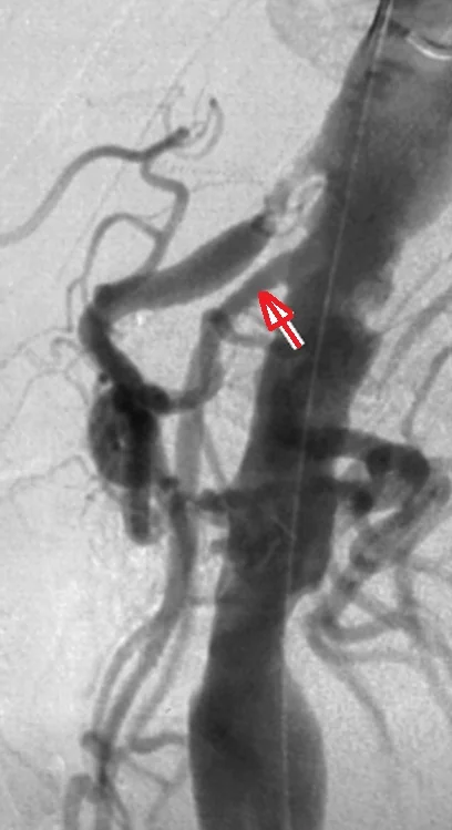 SUPERIOR MESENTERIC ARTERY STENT