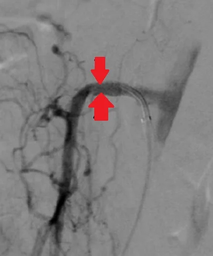 SUPERIOR MESENTERIC ARTERY ISCHAEMIA