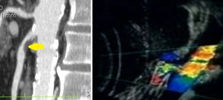 SUPERIOR MESENTERIC ARTERY THROMBOSIS