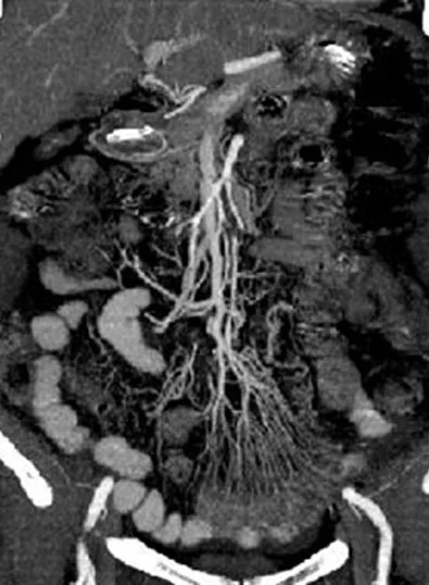 SUPERIOR MESENTERIC ARTERY ISCHAEMIA