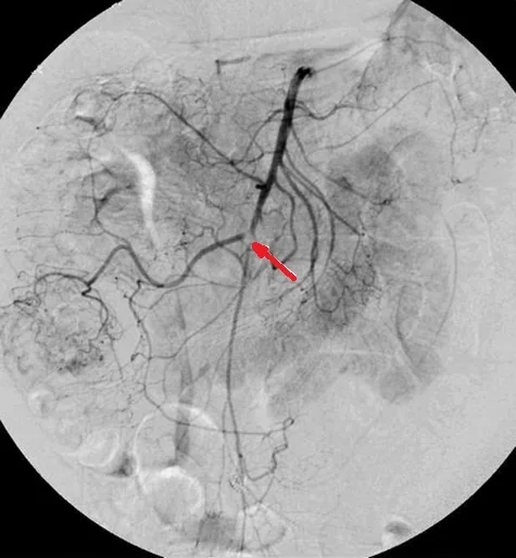 SUPERIOR MESENTERIC ARTERY THROMBOSIS