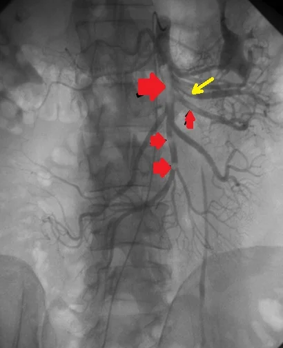 SUPERIOR MESENTERIC ARTERY THROMBOSIS