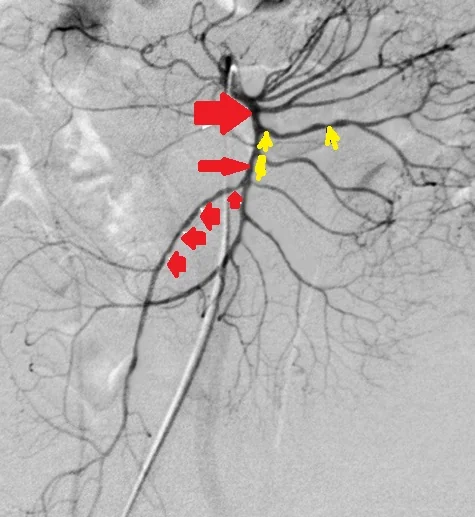 SUPERIOR MESENTERIC ARTERY ISCHAEMIA