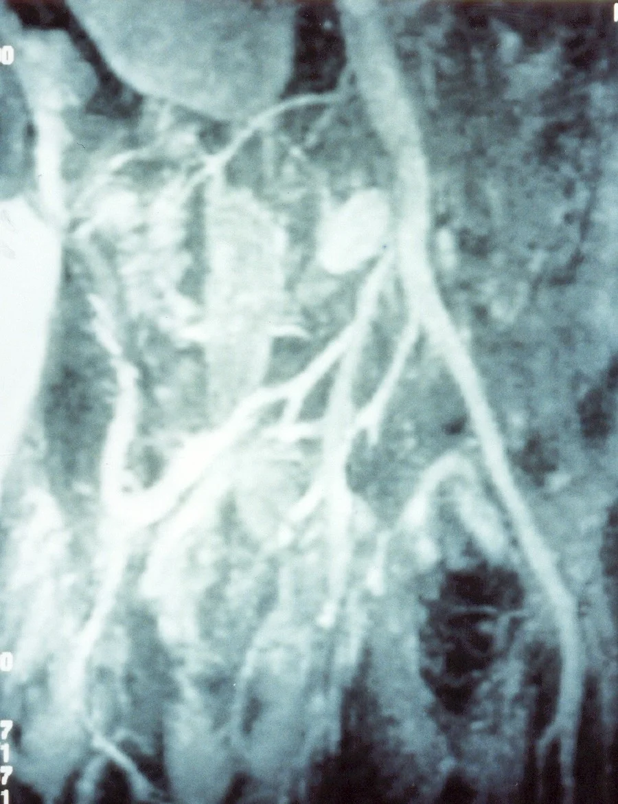 RIGHT COMMON ILIAC ARTERY ANEURYSM