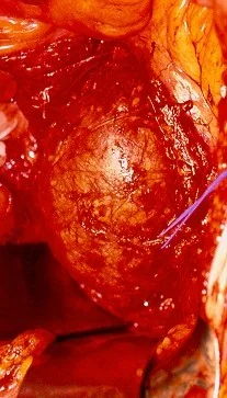 ABDOMINAL AORTIC ANEURYSM