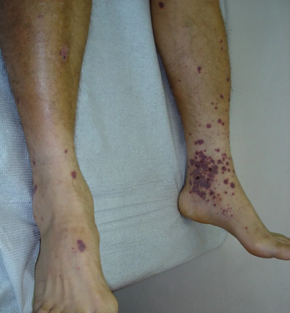 VASCULITIS