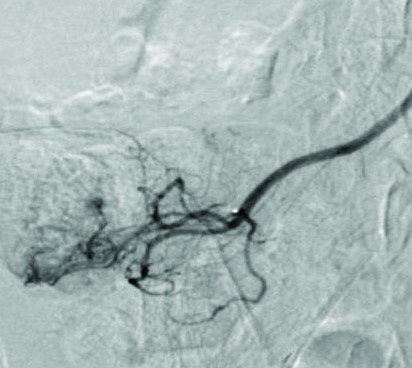 ANGIODYSPLASIA RIGHT COLON