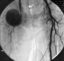 RIGHT FEMORAL ARTERY PSEUDOANEURYSM