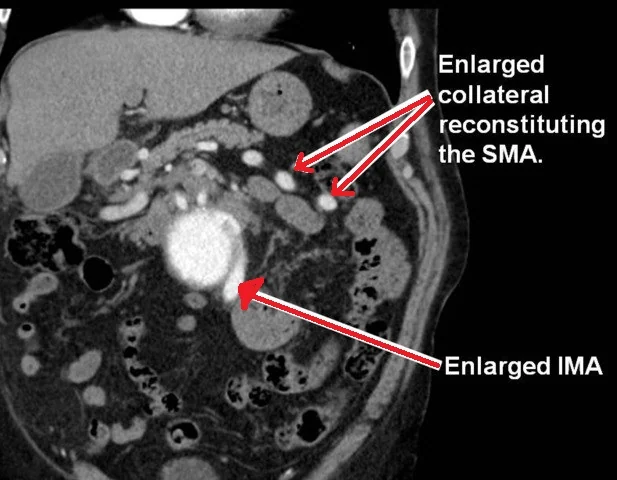 ABDOMINAL AORTIC ANEURYSM REPAIR