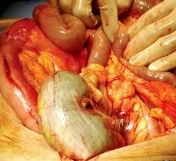 AORTIC ANEURYSM REPAIR - ISCHAEMIC COLITIS