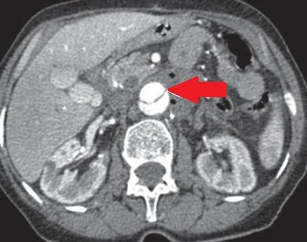AORTIC DISSECTION 