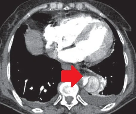 AORTIC DISSECTION 