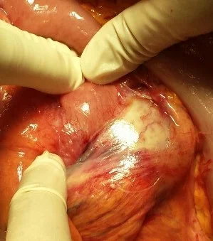 AORTODUODENAL FISTULA