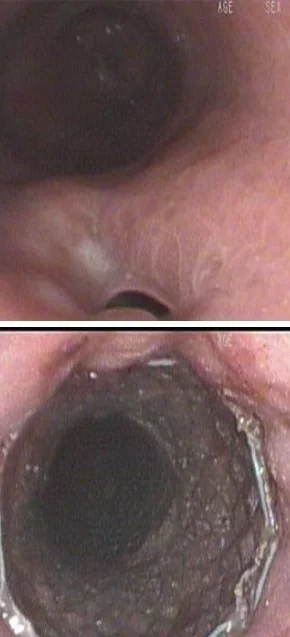 AORTOESOPHAGEAL FISTULA - STENT