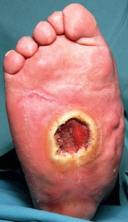 ARTERIAL ULCER 