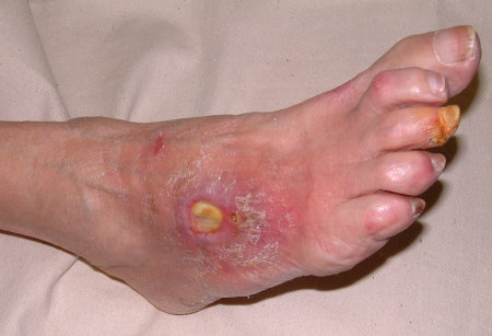 ARTERIAL ULCER