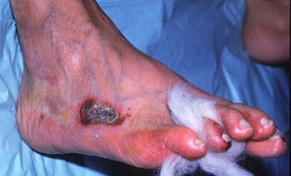 ARTERIAL ULCER