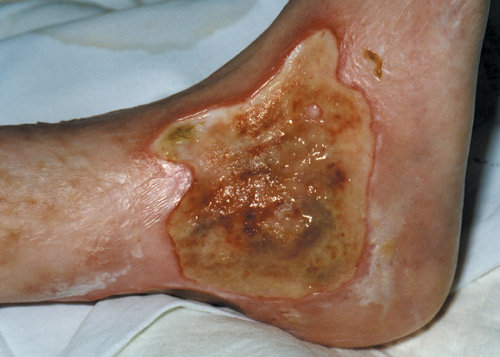 ARTERIAL ULCER