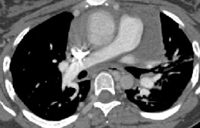 ASCENDING AORTA DISSECTION