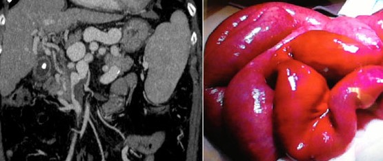 INTESTINAL ISCHAEMIA