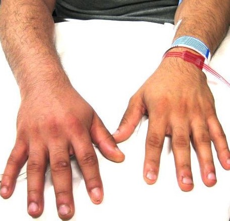 AXILLARY VEIN THROMBOSIS