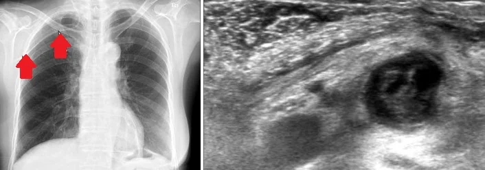 AXILLARY VEIN THROMBOSIS