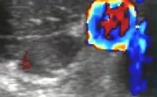 AXILLARY VEIN THROMBOSIS 