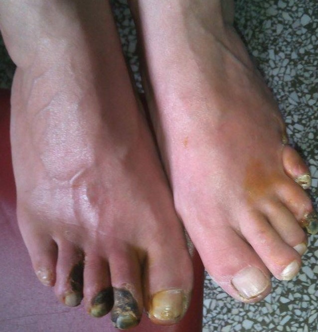 BUERGER'S DISEASE