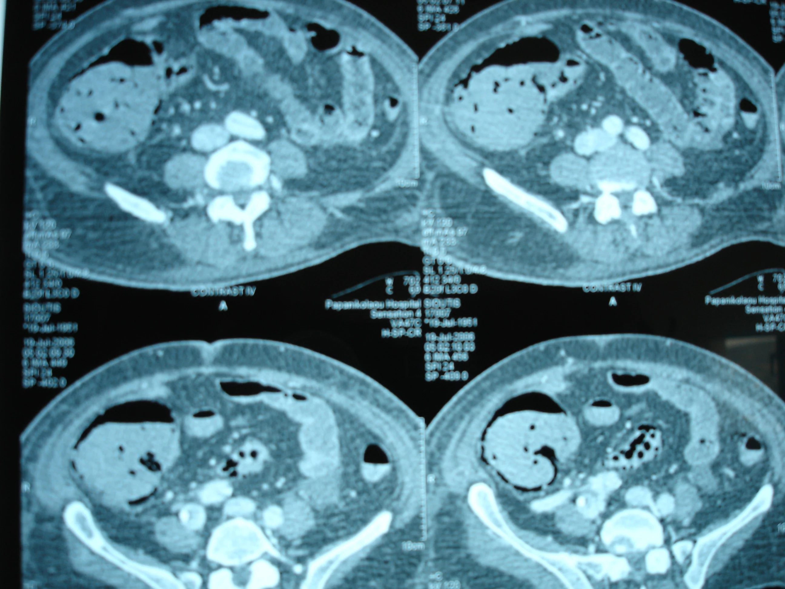 BOWEL ISCHAEMIA