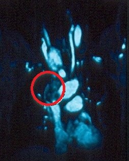 THYROID CARCINOMA - SUPERIOR VENA CAVA SYNDROME