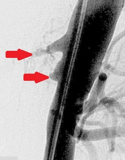 CELIAC AND SUPERIOR MESENTERIC ARTERIES OCCLUSION
