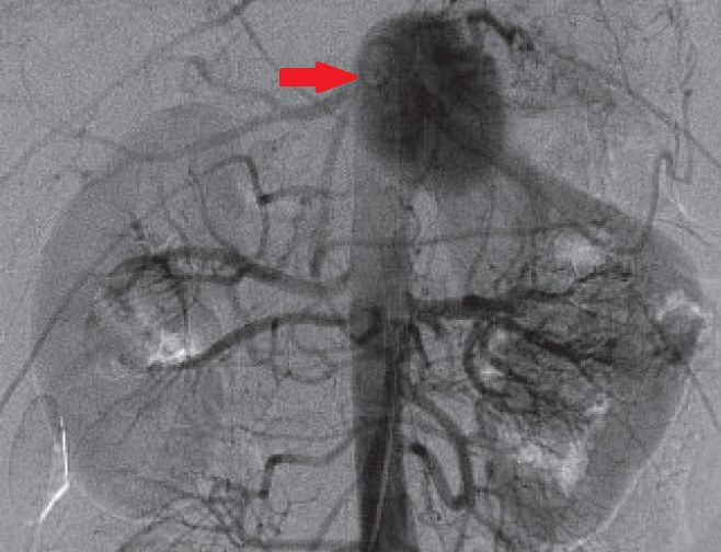 CELIAC ARTERY ANEURYSM 