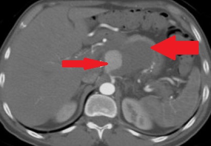 CELIAC ARTERY ANEURYSM 