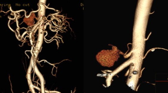CELIAC ARTERY ANEURYSM 