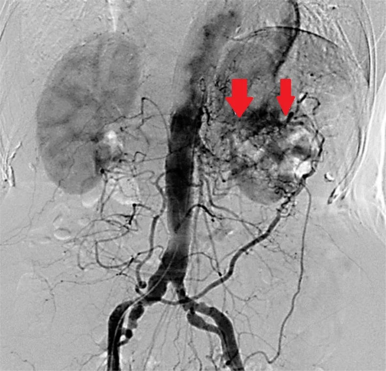 CHRONIC MESENTERIC ISCHAEMIA - ATHEROSCLEROSIS