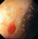 COLONIC ANGIODYSPLASIA 