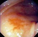COLONIC ANGIODYSPLASIA