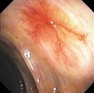 COLONIC ANGIODYSPLASIA