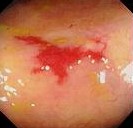 COLONIC ANGIODYSPLASIA