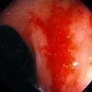 COLONIC ANGIODYSPLASIA