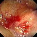 COLONIC ANGIODYSPLASIA