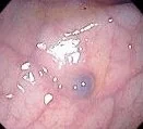 COLONIC PHLEBECTASIA