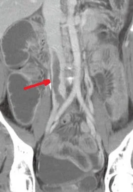 IVC THROMBOSIS