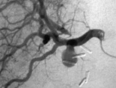 CYSTIC ARTERY PSEUDOANEURYSM